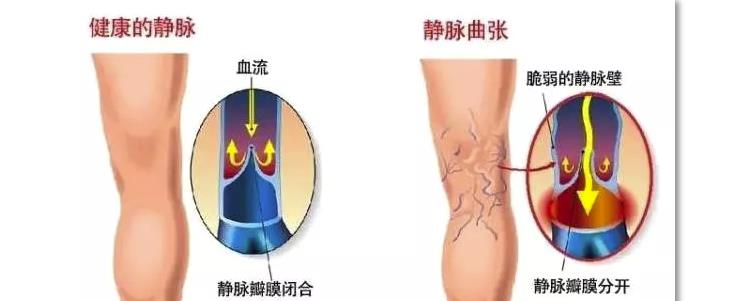 遵义微创静脉曲张半导体激光